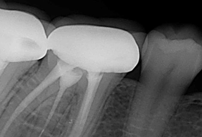 portable dental X-ray machine